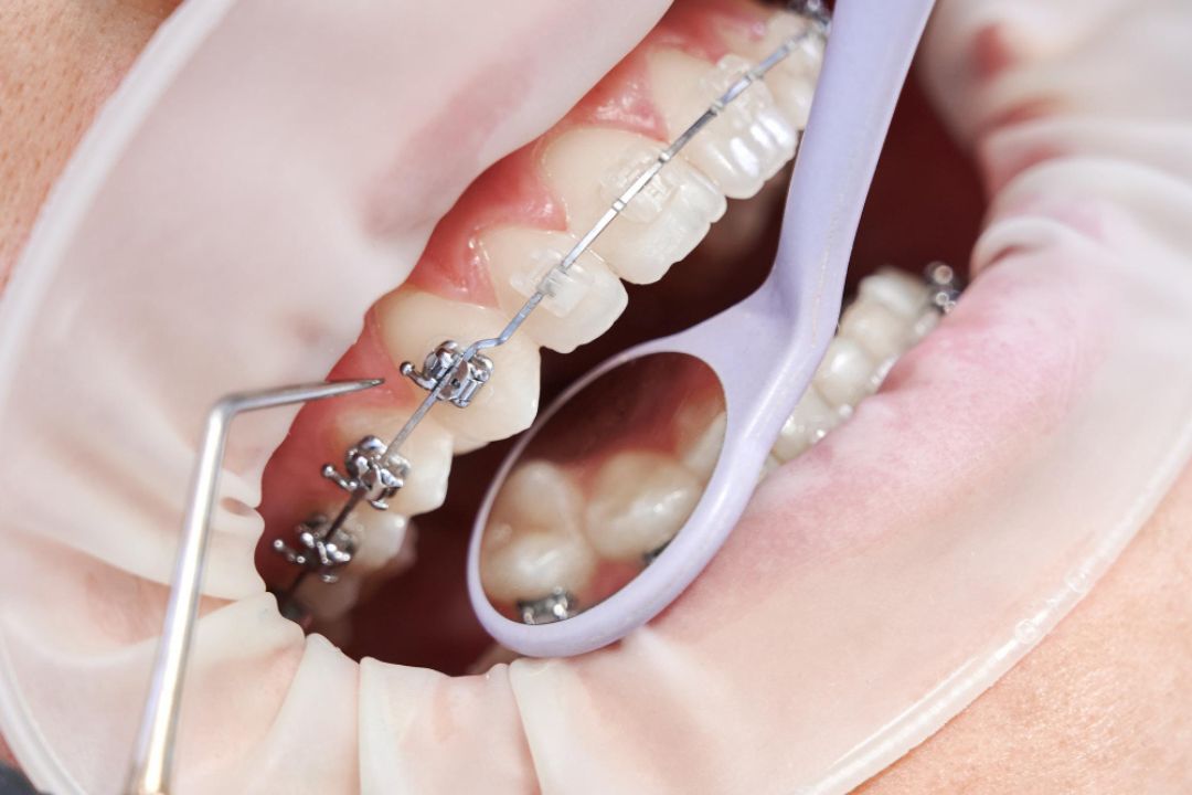 how much do ceramic braces cost in mumbai 